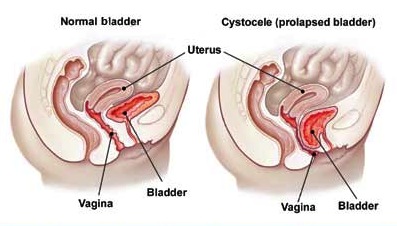 Cystocele