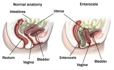 Enterocele