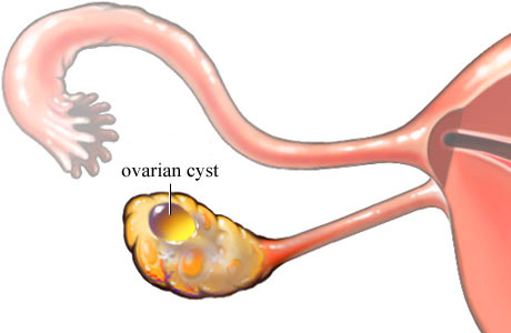 Ovarian Cyst