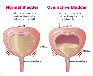 Overactive Bladder