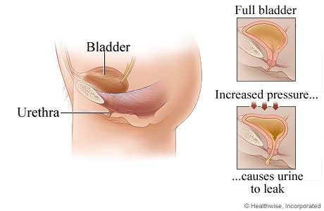 Stress incontinence