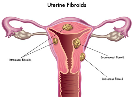 Uterine fibroids.jpg
