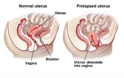 Uterine Prolapse